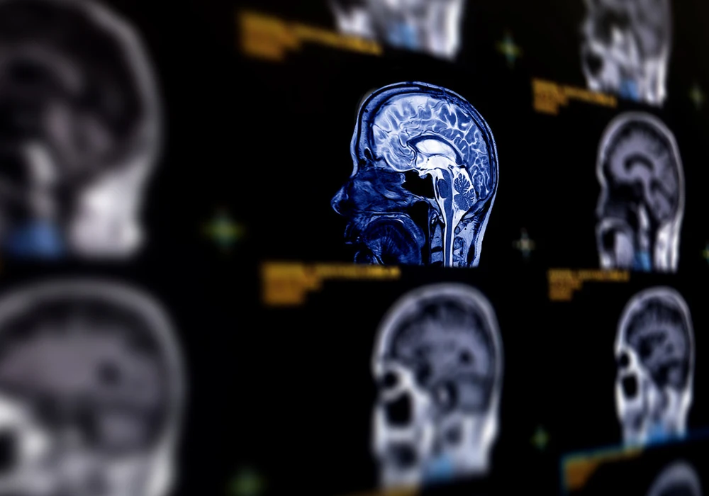 MRI brain scans showing multiple sagittal views, highlighting brain anatomy for neurological assessment.&nbsp;