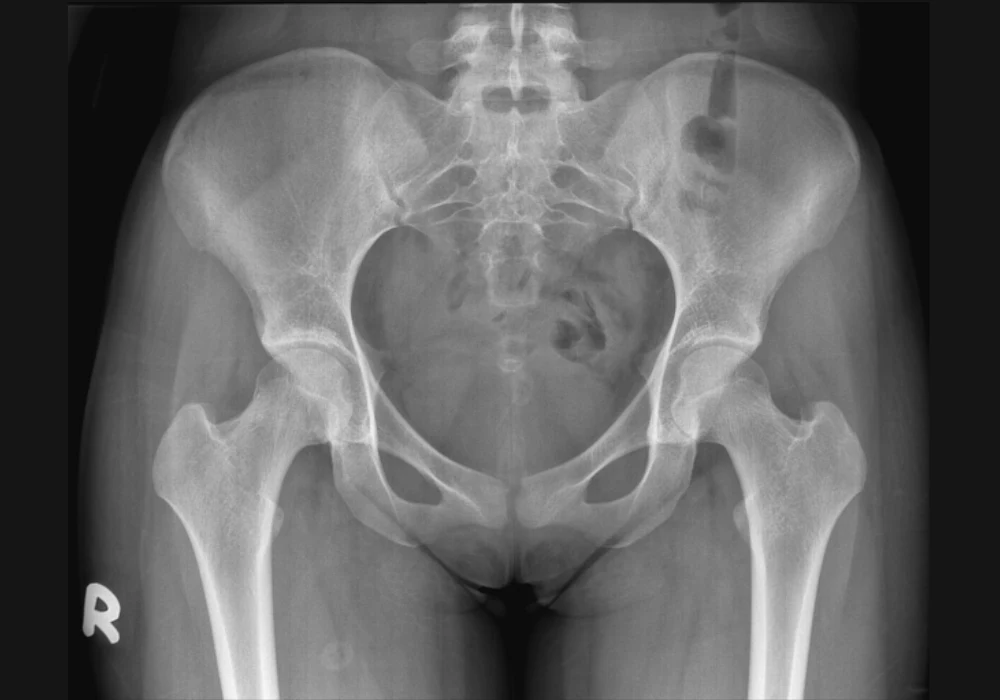 X-ray of a female pelvis and hip joints used to assess bone structure, alignment and fractures.