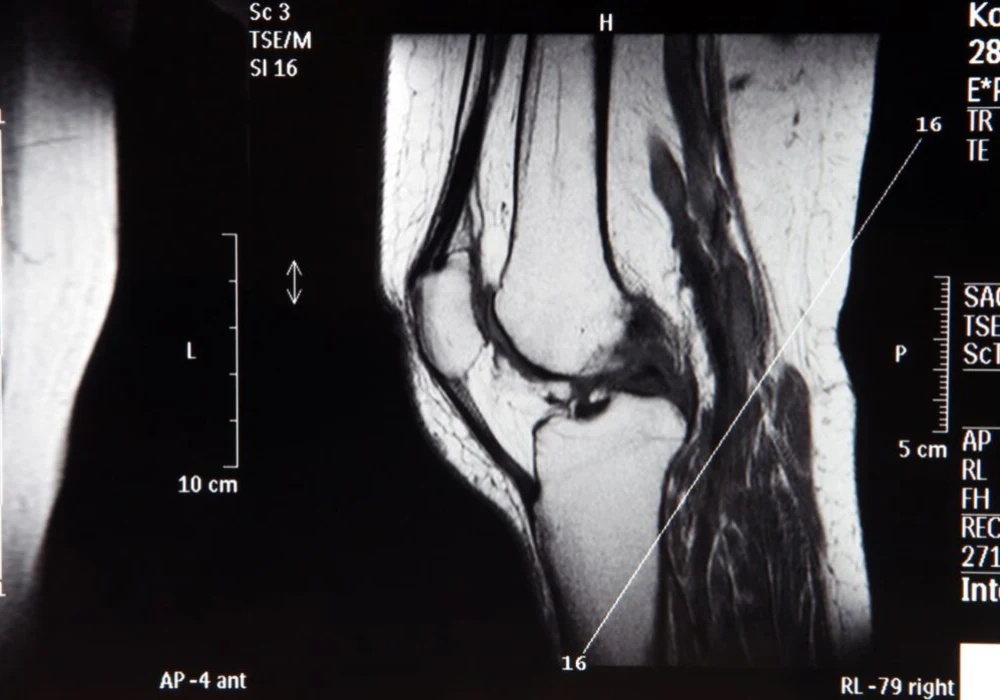 MRI scan image of a human knee joint in sagittal view, showing detailed bone, cartilage, and soft tissue structures used for diagnostic evaluation.&nbsp;