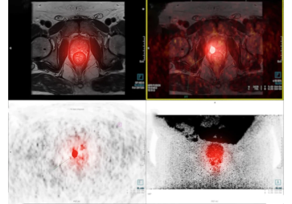 Medical imaging comparison of a prostate lesion across different modalities: MRI, PET, and CT scans, with highlighted areas showing signs of cancerous activity.&nbsp;