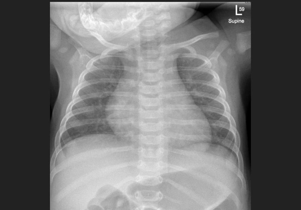 An AP chest pediatric X-ray&nbsp;
