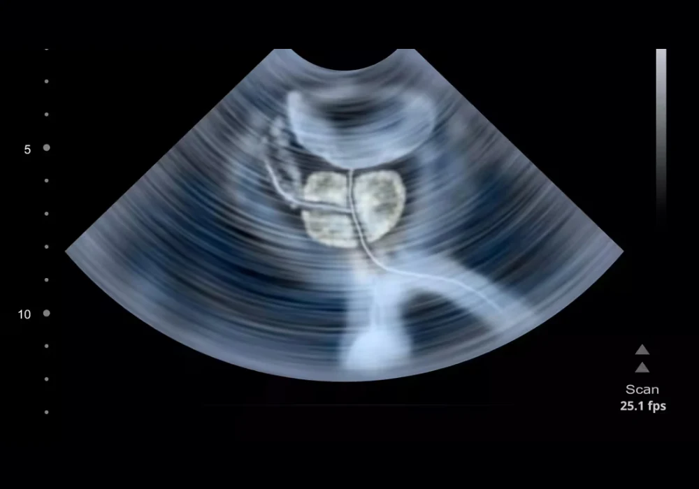 Transrectal ultrasound showing the prostate gland for urology imaging and diagnosis.&nbsp;