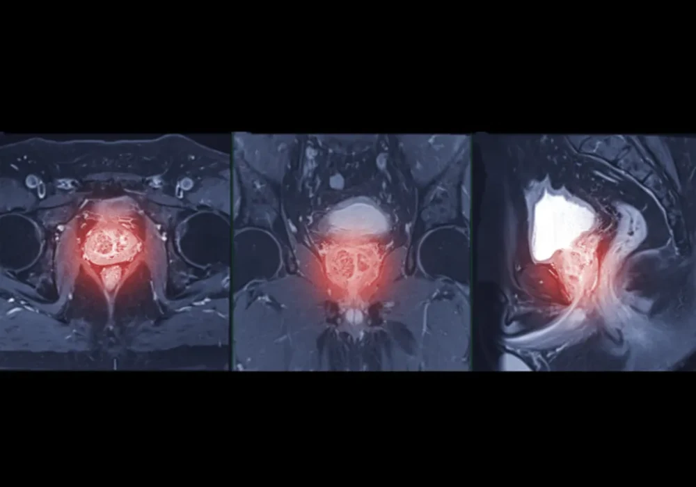 Pelvic MRI series in axial, coronal and sagittal views with the prostate region highlighted.&nbsp;
