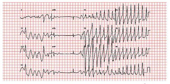 ESC 2014: Expert Consensus on Ventricular Arrhythmias