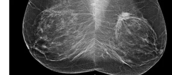 RSNA 2013: Breast Cancer Prognosis Potentially Affected by Screening Intervals 