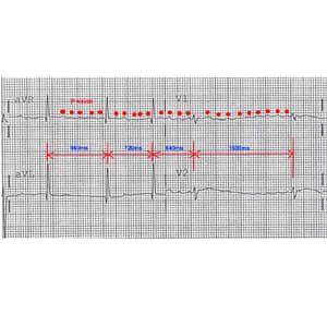 Social Inequality, Lifestyle and Heart Disease