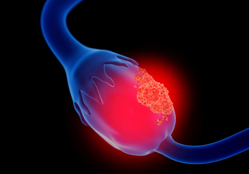 Transforming Ovarian Cancer Prognosis with Radiomics