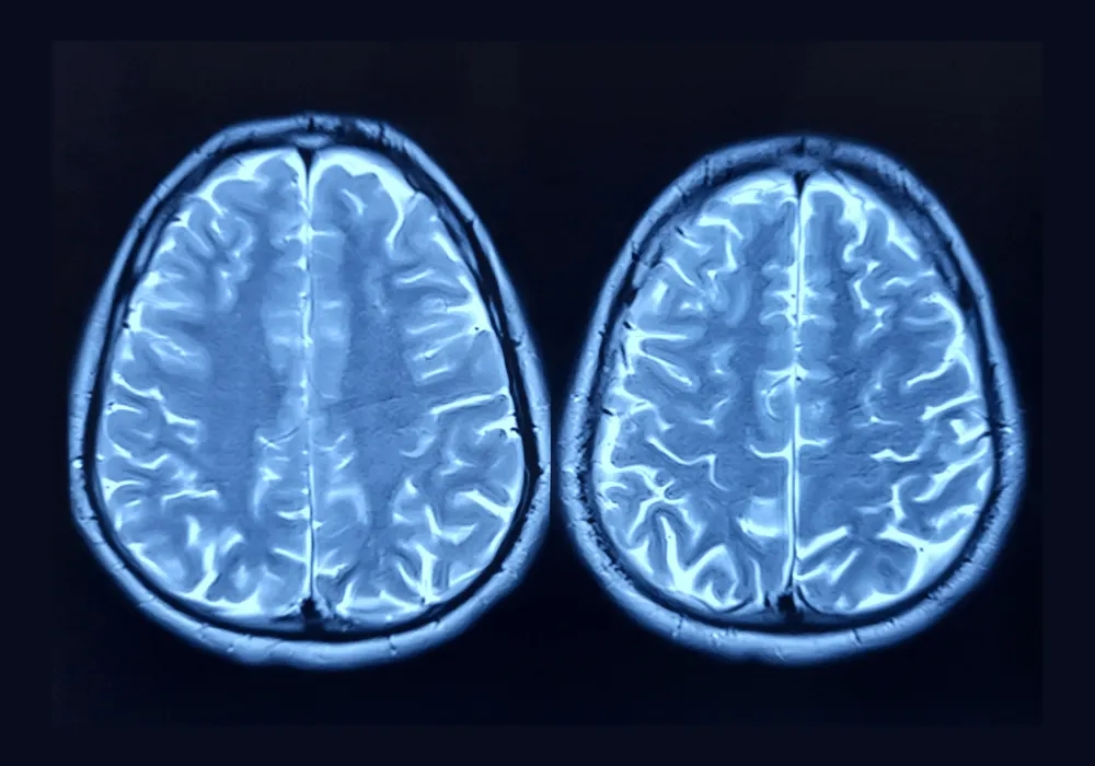 Optimising Multimodal Prompts for GPT-4V in Brain MRI Diagnosis