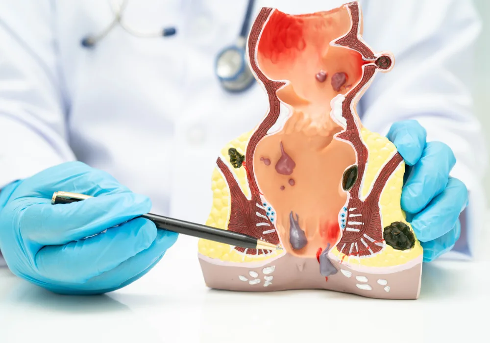  Doctor pointing to anatomical model of human rectum and anus, demonstrating haemorrhoids, anal fissures and common proctological conditions for medical education and diagnosis.&nbsp;