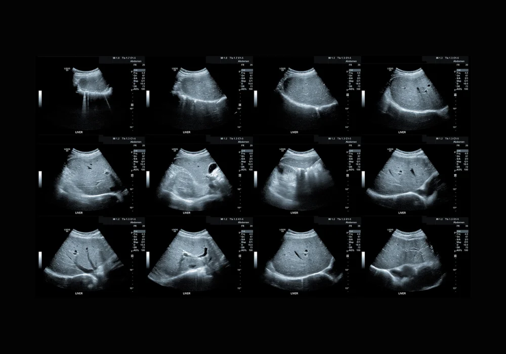 Series of liver ultrasound scan images used for diagnostic evaluation in abdominal imaging&nbsp;