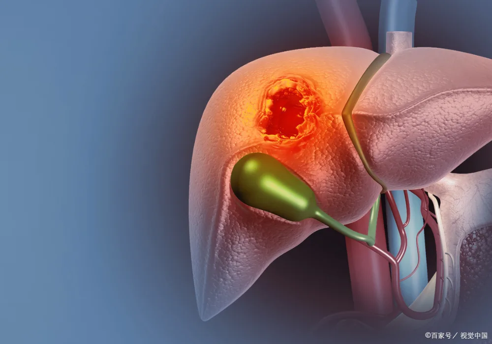 Medical illustration of a liver with&nbsp;a focal&nbsp;tumour.&nbsp;