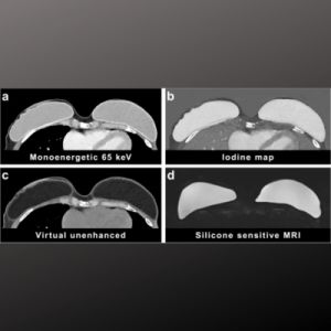 Assessing Silicone Breast Implants Ruptures with PCCT