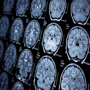 Enhancing Brain Metastases Visualisation With Dynamic Contrast-Enhanced MRI