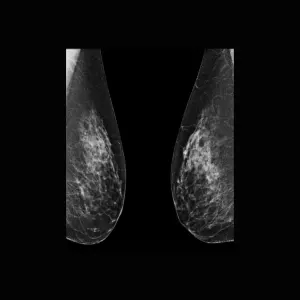 Abbreviated MRI as a Supplemental Cancer Screening Tool for Dense Breasts
