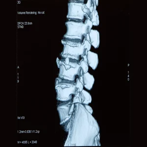3D CT scan of the lumbar spine showing vertebrae and degenerative structural changes.&nbsp;