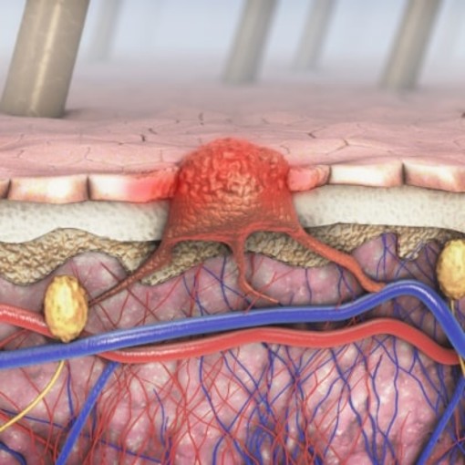 Increased Risk of Skin Cancer After Radiation Therapy Breast Cancer Treatment