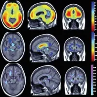 Obesity/physical activity and brain structure