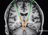 Dentatorubrothalamic tract (DRT)