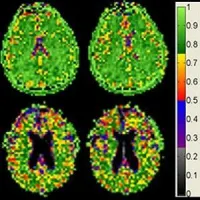 MRI: brain cell density