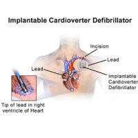 Implantable Cardioverter Defibrillator