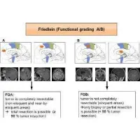 The Friedlein Grading A/B classification system 