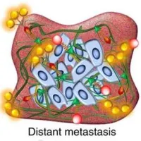 early spread of breast cancer detected by MRI