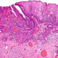 (micrograph) intramucosal oesophageal adenocarcinoma 