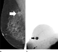 suspicious lesion (arrow) at screening mammography