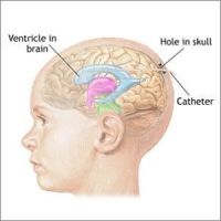 intracranial pressure monitoring (ICP)