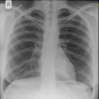 chest x-ray close-up