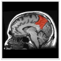 sagittal MRI slice with the precuneus shown in red