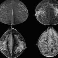 Four different categories of breast density: fatty (top left), scattered fibroglandular (top right), heterogeneously dense (bottom left) and extremely dense (bottom right).