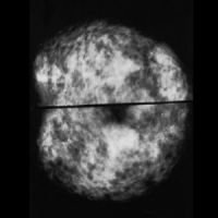 two mammograms of normal dense breasts