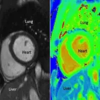 Black and white MRI pictures (left) to diagnose heart disease used today which can be very subjective. These could be replaced with colour coded pictures in the future. 