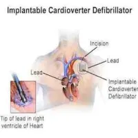 Implantable Cardioverter Defibrillator 