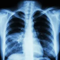 X-ray showing ventilator-associated pneumonia (credit: American Thoracic Society)