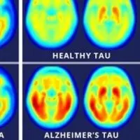 A study using a new PET imaging agent shows that measures of tau protein in the brain more closely track cognitive decline due to Alzheimer&#039;s disease compared with long-studied measures of amyloid beta. More red color indicates more tau protein