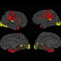 Dynamic cerebral reorganisation in the pathophysiology of schizophrenia: a, MRI-derived cortical thickness study. Credit: Lena Palaniyappan