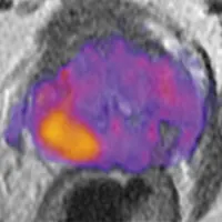 A magnetic resonance image (MRI) of a prostate enhanced with restriction spectrum imaging (RSI). Higher grade tumour is indicated by orange and yellow