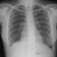 X-ray of injured lung