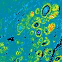 This image shows DCIS sample highlighting aggressive biomarkers. Credit: University of Michigan Health System