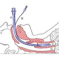 Ventilation: Weaning/Post-extubation Management