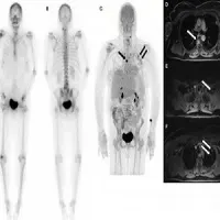 Tc-99m MDP bone scan (left) is negative for osseous lesions. NaF/FDG PET/MRI (right and second slide) confirms absence of bone metastases, but shows liver metastases.