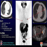 A 77-year-old male with recurrent lymph node and pulmonary metastases detected by Ga-68 PSMA PET/CT but not by conventional imaging.