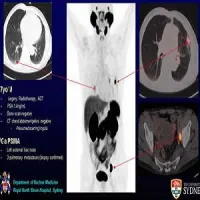 A 77-year-old male with recurrent lymph node and pulmonary metastases detected by Ga-68 PSMA PET/CT but not by conventional imaging.