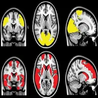 MR images show reduced regional functional connectivity in, A, Parkinson&rsquo;s disease (PD) patients and, B, exclusively in PD + visual hallucinations (VH) patients. Regional functional connectivity analysis revealed lower functional connectivity in PD + VH a