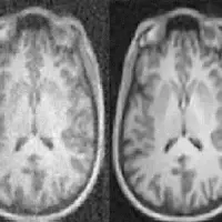 Shown here are MR images reconstructed from the same data with conventional approaches (left) and AUTOMAP (right).
