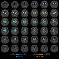 Image shows voxelwise analysis of quantitative susceptibility maps within thalamus, caudate, globus pallidus, and putamen comparing all participants with multiple sclerosis (MS) to healthy control (HC) participants. Areas of higher susceptibility in parti