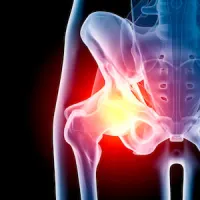 Hip arthritis