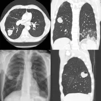 Cancer Screening Drops after Diagnostic CT